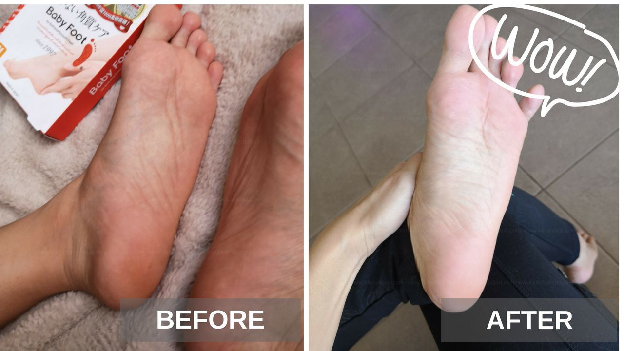 Baby Foot Peel DIY
 Baby Foot Peel Review with Before and After