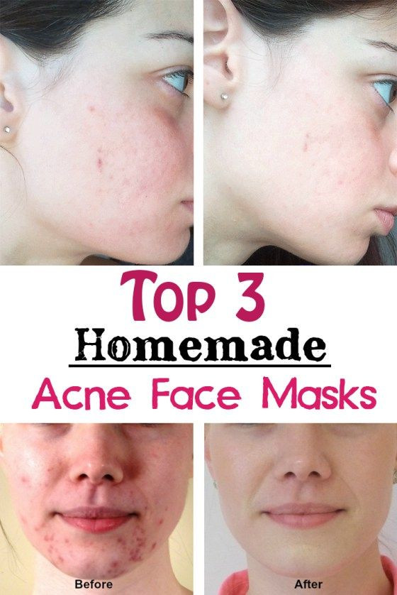 DIY Face Mask For Acne And Blackheads
 Top 3 Homemade Acne Face Masks