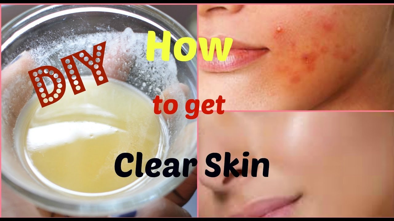 DIY Face Mask For Acne Scars
 DIY Face Mask to Get Rid of Acne & Acne Scars FAST