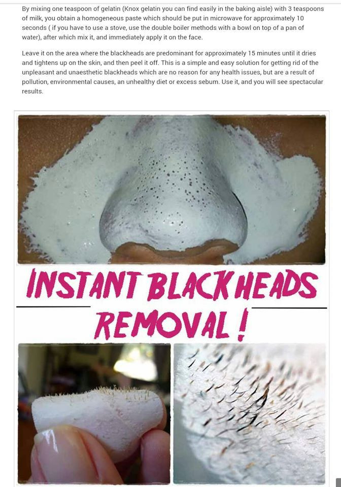 DIY Face Mask To Remove Blackheads<br />
 Homemade Blackhead Removal Hair and Beauty