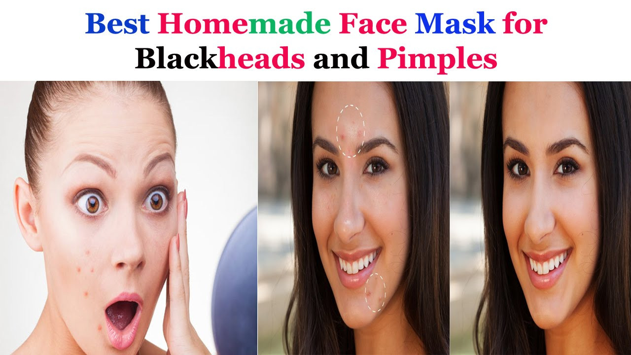 DIY Facemask For Pimples
 Best Homemade Face mask for Blackheads and Pimples