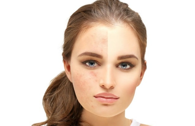 DIY Facial Mask For Acne Scars
 8 Effective Natural DIY Homemade Face Masks for Acne Scars