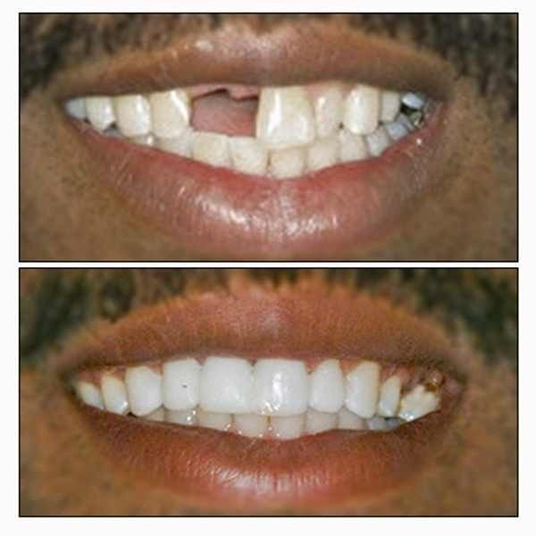 DIY False Teeth Kit
 TEMPORARY TOOTH REPAIR or REPLACE KIT DIY makes 25 30