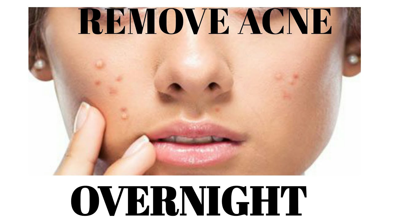 DIY Overnight Face Mask For Acne
 DIY HOMEMADE FACE MASK FOR ACNE ACNE OVERNIGHT TREATMENT