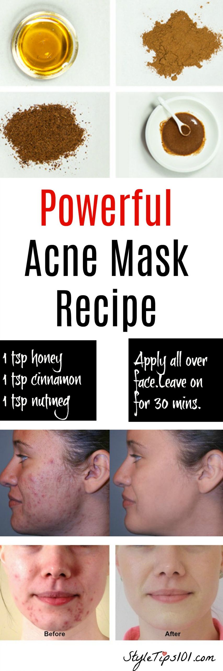 DIY Overnight Face Mask For Acne
 Homemade Natural Acne Mask