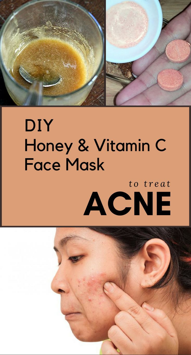 DIY Vitamin C Mask
 DIY Honey & Vitamin C Face Mask To Treat Acne