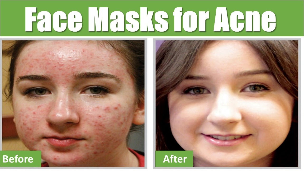 Face Masks For Acne DIY
 Easy DIY Homemade Natural Face Masks for Acne