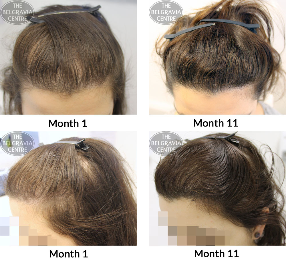 Hairstyles For Female Hair Loss
 The Best Hairstyles Female Pattern Baldness Home Family