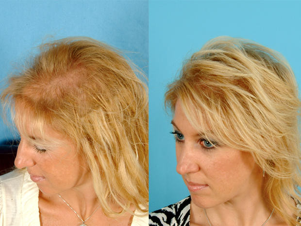Hairstyles For Female Hair Loss
 Stress high hormone levels Eek Hair loss in women Top