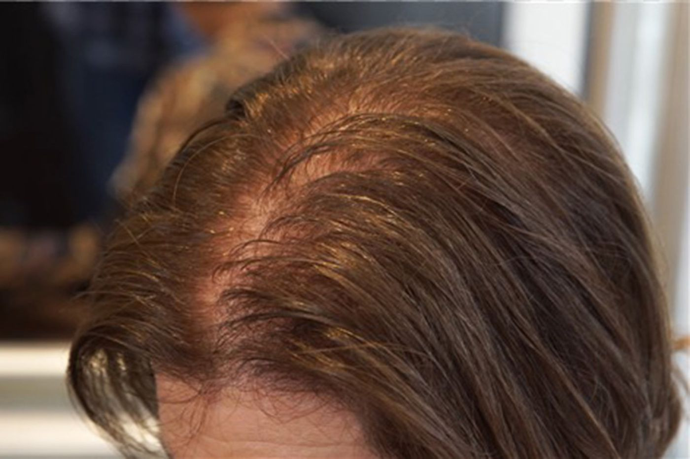 Hairstyles For Female Hair Loss
 As they age women lose their hair too Which treatments