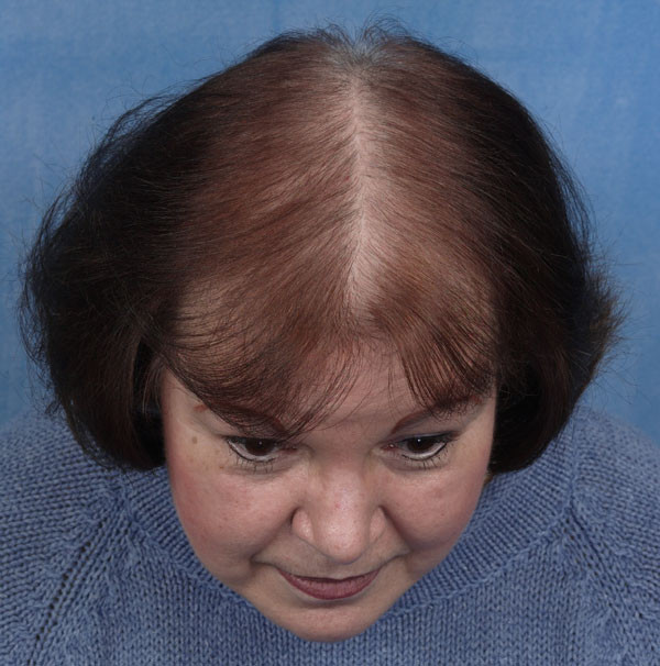 Hairstyles For Female Hair Loss
 what cause hair loss All About hair loss