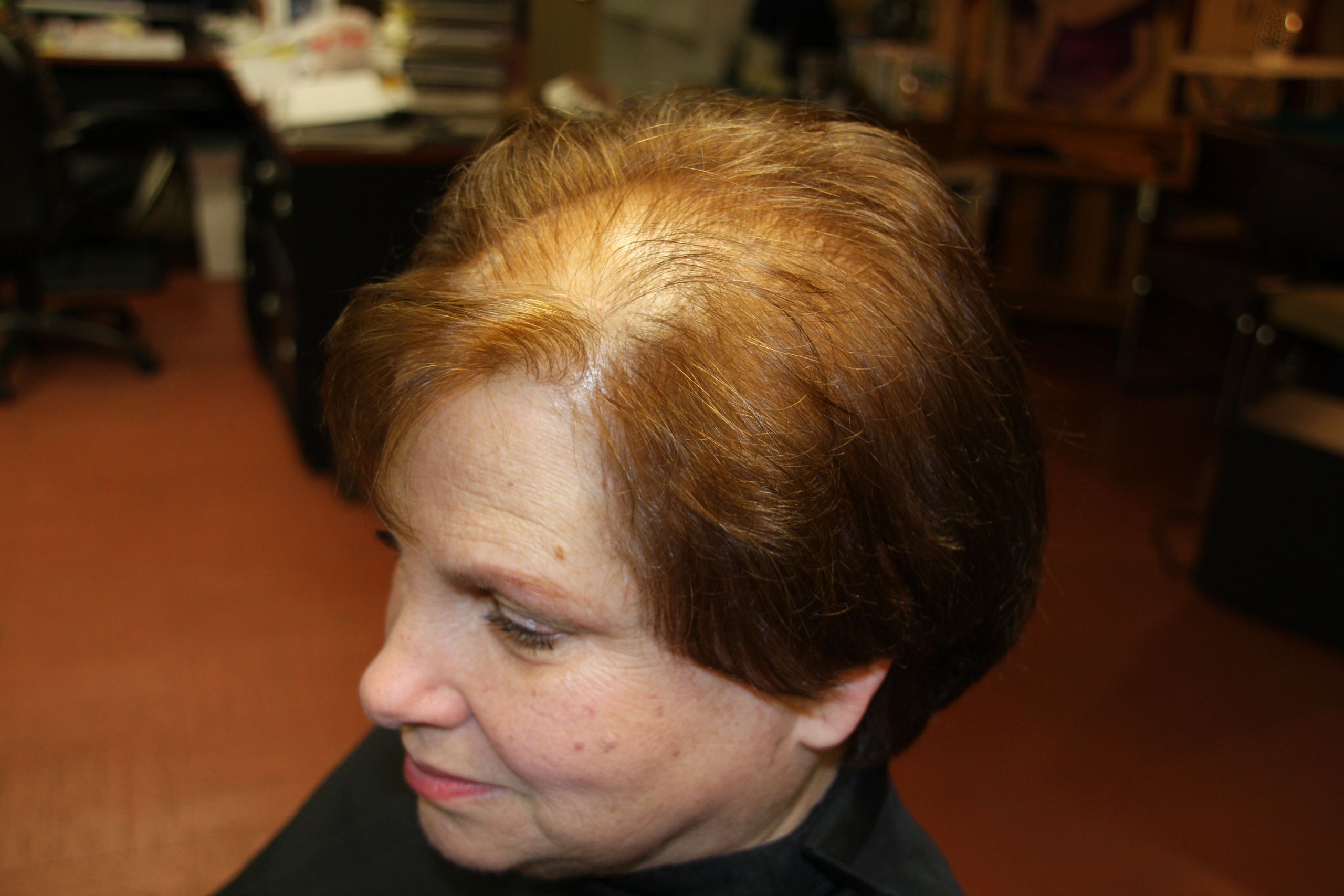 Hairstyles For Female Hair Loss
 Hair Replacement Alopecia Hair Loss Treatments Baldness