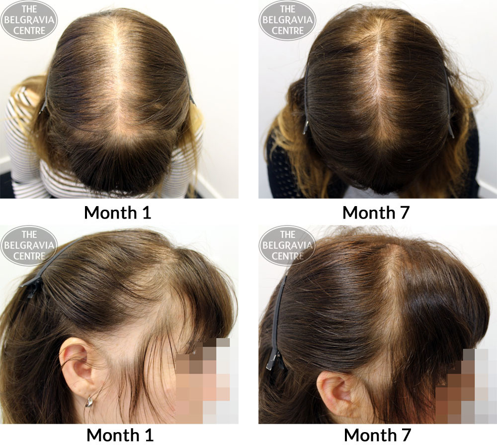 Hairstyles For Female Hair Loss
 Success Story Alert New Women’s Hair Loss Treatment Entry